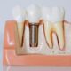 dental implant recovery