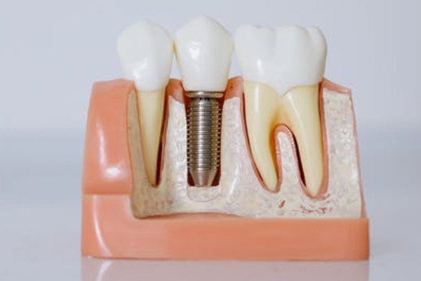 dental implant recovery