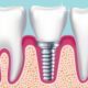 options for missing teeth